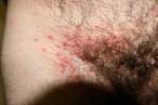 rash2_large.jpg